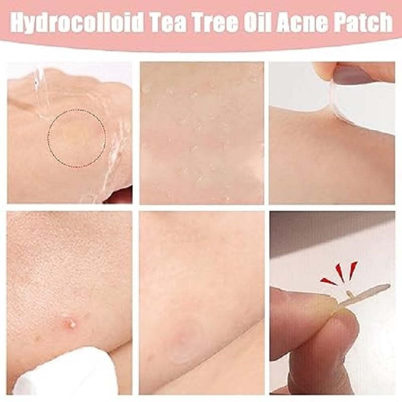 Pimple Patch for Acne & Blemish Removal - 144 Dots