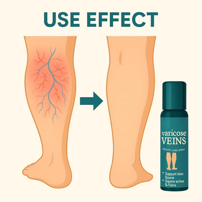 Varicose Veins Spray | Quick Relief from Leg Pain – 30ml (Pack of 1)