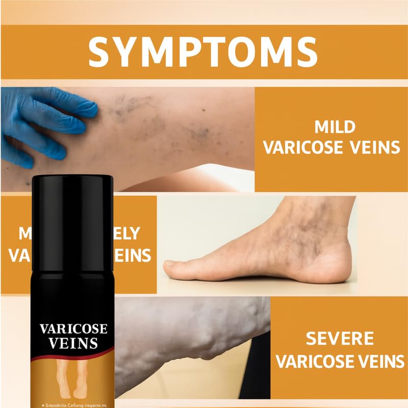 Varicose Veins Spray | Quick Relief from Leg Pain – 30ml (Pack of 1)