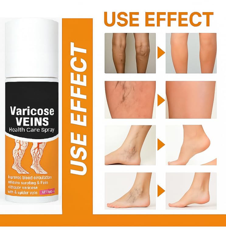 Varicose Veins Pain Relief Spray – 60ml (Pack of 1)