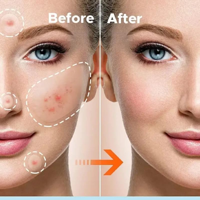 Pimple Patch for Acne & Blemish Removal - 144 Dots