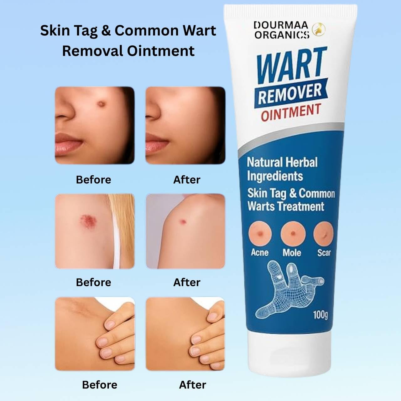 Wart Remover Ointment for Safe & Effective Skin Wart Removal-100g (Pack of 2)