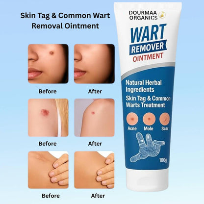 Wart Remover Ointment for Safe & Effective Skin Wart Removal-100g (Pack of 2)