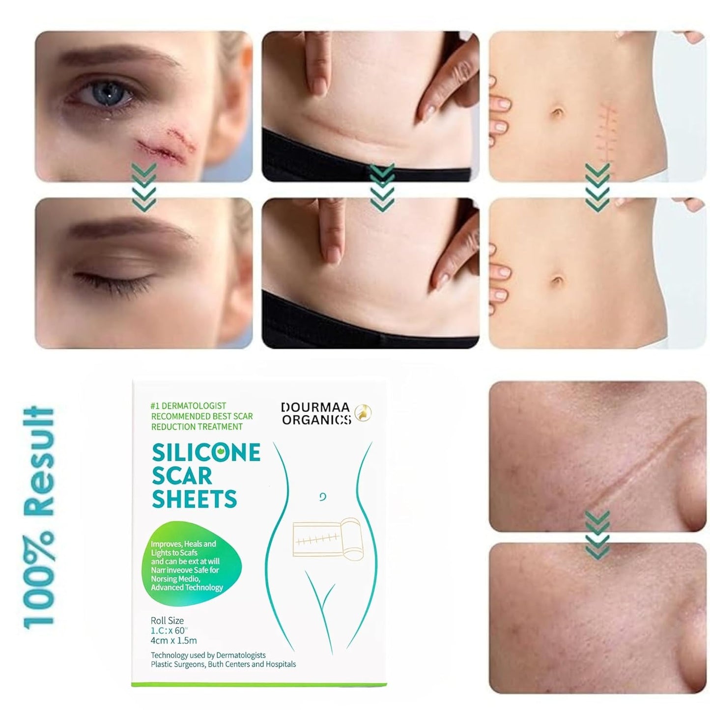 Reusable Silicone Scar Sheets for Old & New Scar Treatment
