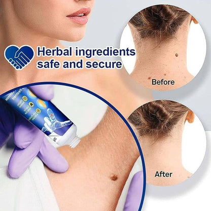 Wart Remover Ointment for Safe & Effective Skin Wart Removal-100g (Pack of 2)